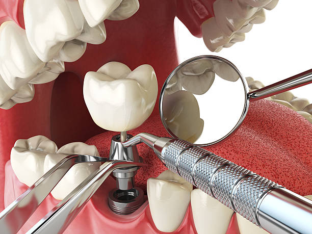 Best Emergency Tooth Extraction in Kissimmee, FL